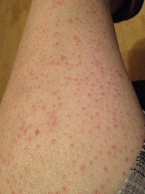Niacinamide calms the redness. The skin looks quieter.