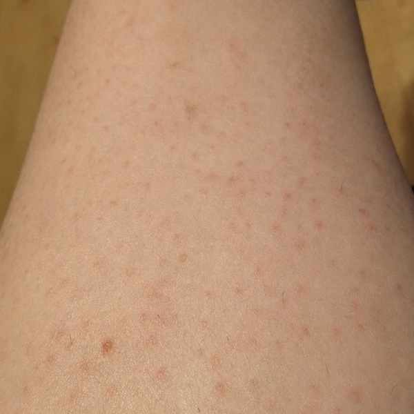 Niacinamide calms the redness. The skin looks quieter.