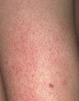 Keratin plug blocking the follicle