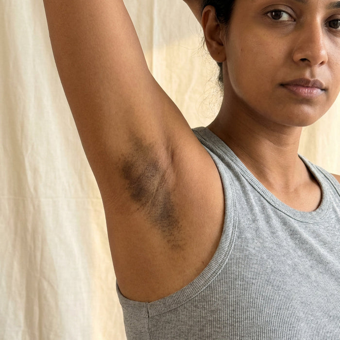 South Asian woman before — PIH visible