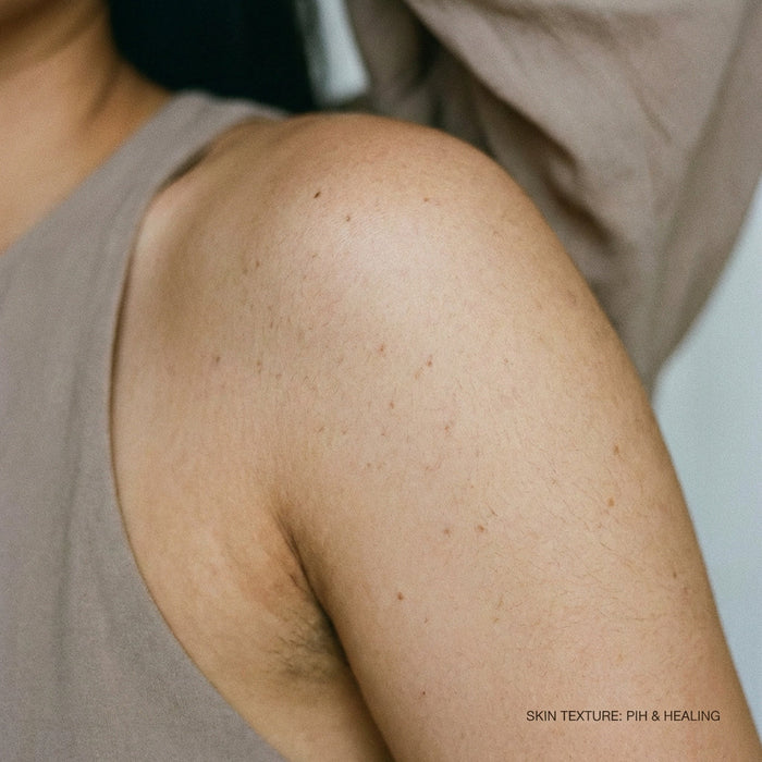 Post-inflammatory hyperpigmentation